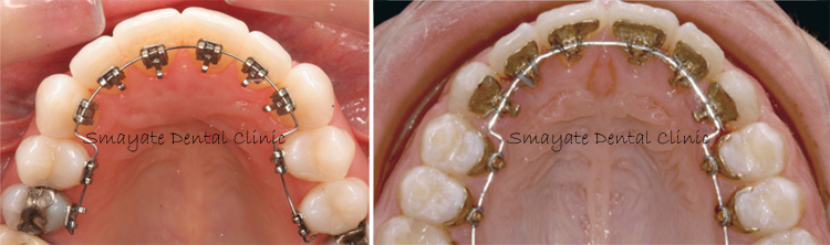 Aviara Centers  Lingual Braces: Your Guide to the Invisible
